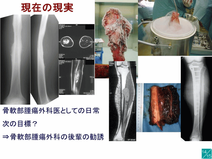 現在の骨軟部腫瘍外科に関する講演資料で、X線画像や手術中の写真が含まれています。