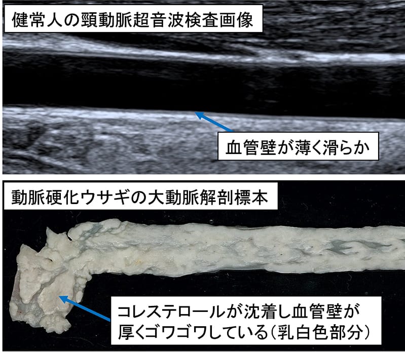 健康な人の頸動脈超音波検査画像と動脈硬化の標本を示す。血管の状態を比較する。