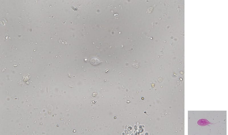 顕微鏡で観察されたランブル鞭毛虫の画像。右下には赤く染色された原虫が示されています。