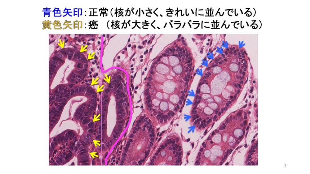 大腸癌の病理組織像。正常な細胞と異常な細胞の違いが示されている。