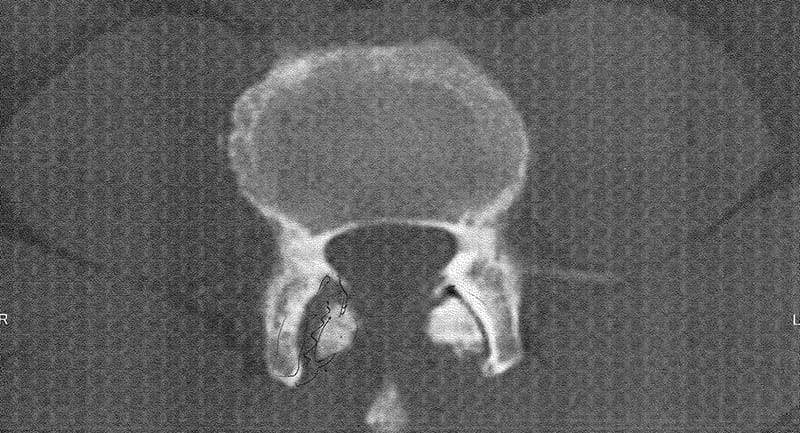 CT画像に映る椎間関節の断面。炎症により変化が見られ、医師による説明が行われた。