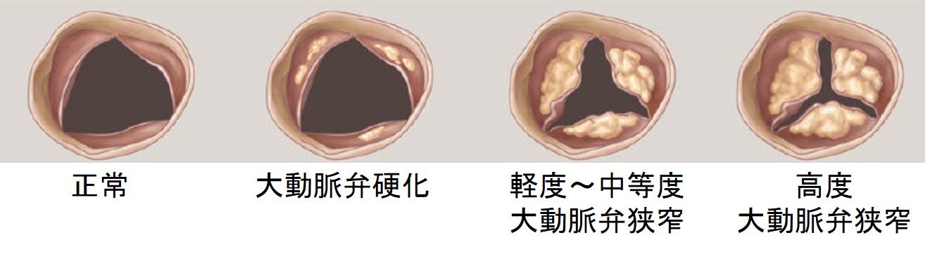 大動脈弁の状態を示すイラスト。正常、大動脈弁硬化、軽度から中程度の狭窄、高度の狭窄の4つの状態が描かれている。