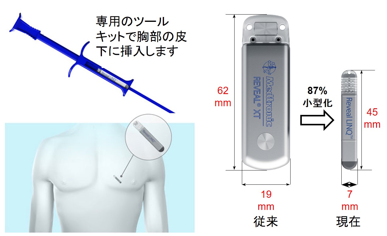 植え込み型心電図記録計とその挿入方法を示す画像。胸部に装置を埋め込むための専用ツールが描かれている。