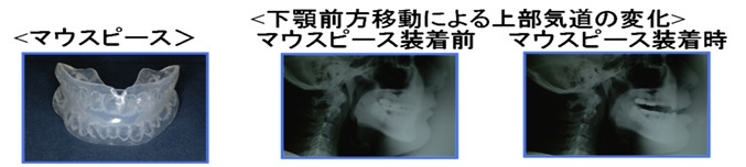 マウスピースの画像。左側には透明なマウスピース、中央と右側には装着前後の口腔内のX線画像が表示されています。