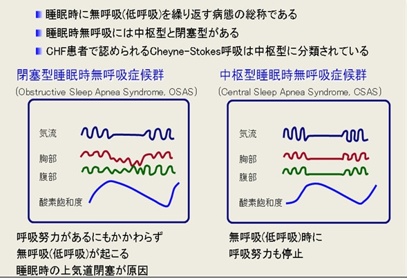 睡眠時無呼吸症候群の分類を示す図。閉塞型と中枢型の特徴をグラフで比較。