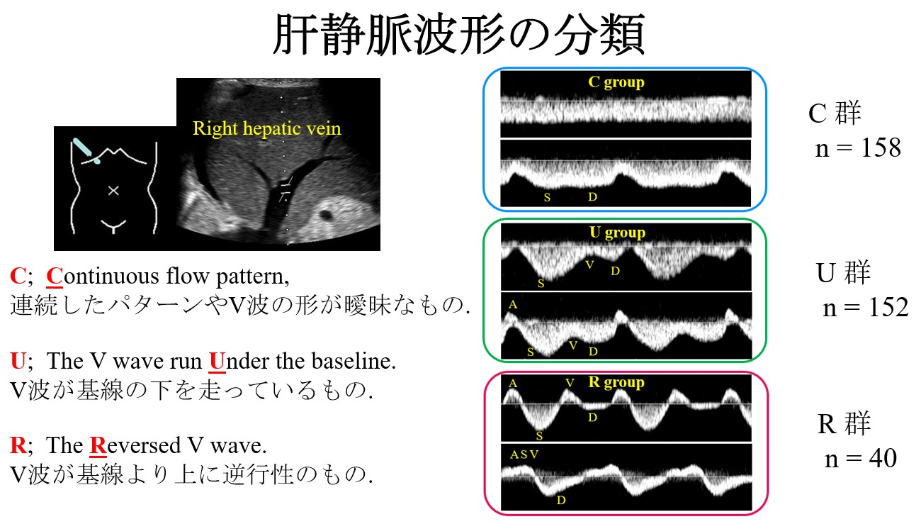 肝静脈波形の分類に関する図で、3つのグループ（C、U、R）の波形パターンが示されている。各グループのサンプル数も記載。