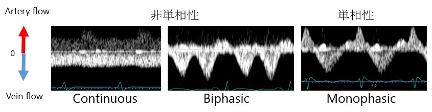 動脈と静脈の流れを示すグラフが3つあり、連続、二相性、単相性の波形が表示されています。