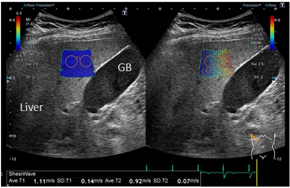 超音波画像で、左に「Liver」と右に「GB」とラベルされた部分が表示され、青色のボックス内には測定データが示されている。
