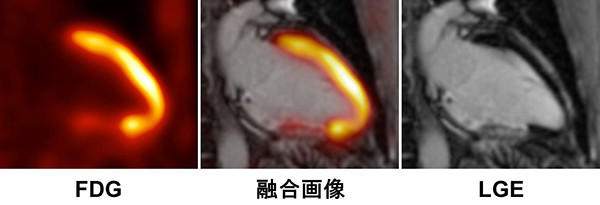 三つの画像が並び、左からFDG、融合画像、LGEと示されている。中央の融合画像にはFDGの色が追加されている。