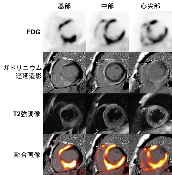 心臓の各部位（基部、中部、心尖部）の医療画像。FDG、ガドリニウム遅延造影、T2強調像、融合画像がそれぞれ表示されている。