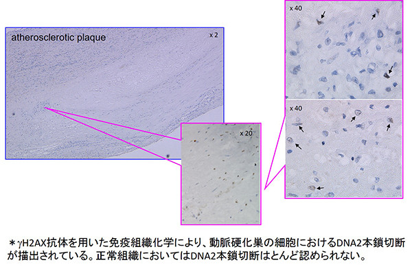 動脈硬化性プラークの顕微鏡画像、γH2AX抗体による免疫組織化学でDNA2本鎖切断が示され、細胞の詳細が倍率別に示されている。