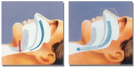 CPAPを使用前と使用中の図