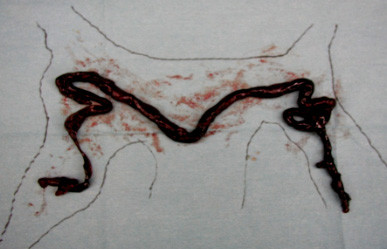 手術で摘出された肺動脈の血栓が白い布の上に置かれている様子。