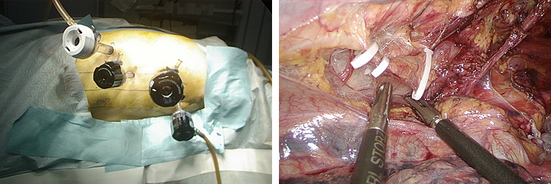 胸腔鏡下食道亜全摘術の手術器具と手術部位の画像。