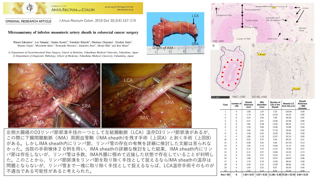 大腸癌手術における下腸間膜動脈鞘の微細解剖を示す画像。手術中の器具と組織が映っている。