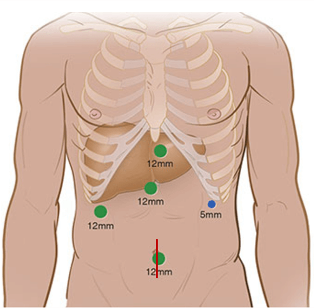 腹腔鏡下手術の皮膚切開位置を示す図。肋骨と肝臓の位置関係が描かれている。