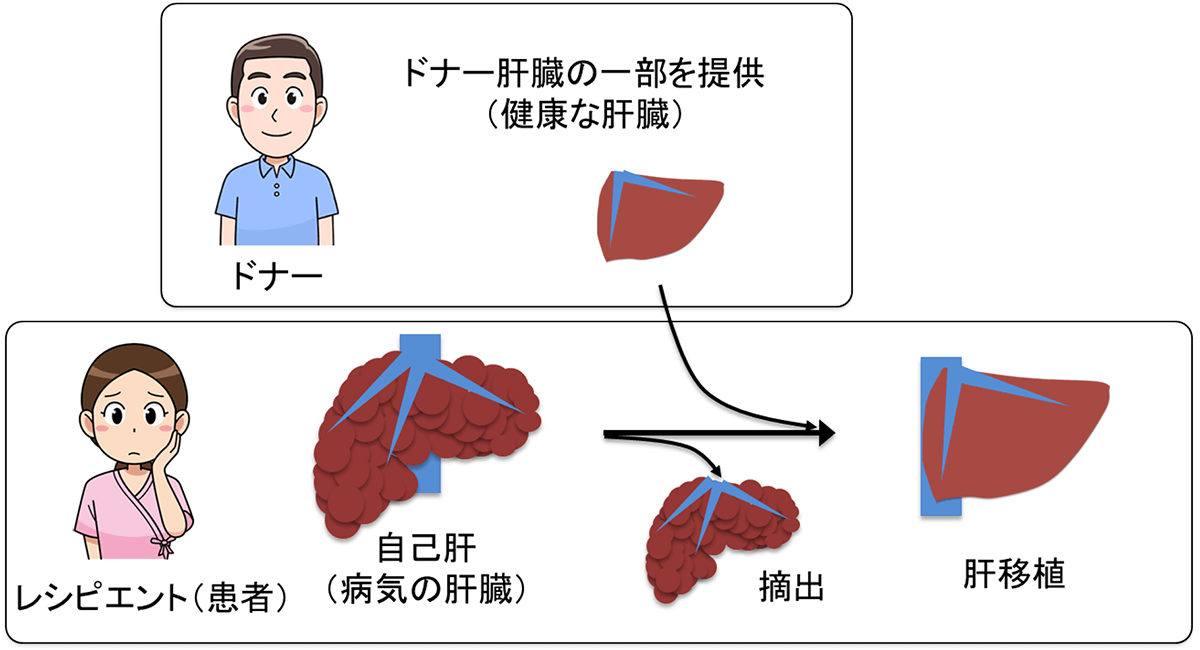 生体肝移植の概要を示すイラスト。ドナーから提供された健康な肝臓と、病気の肝臓を持つレシピエントの図解。