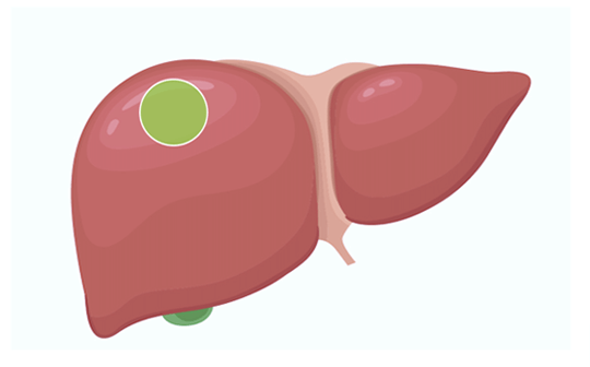 肝臓のイラストで、肝細胞癌を示す緑色の腫瘍が描かれています。
