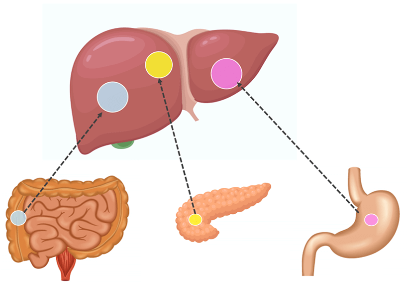 肝臓と他の臓器（腸、膵臓、胃）を示すイラストで、転移性肝癌の発育を説明する図。