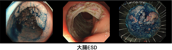 内視鏡による大腸の観察画像。潰瘍性大腸炎や腫瘍の診断に関連する病変が確認できる。