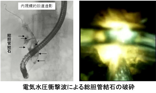 内視鏡を用いた電気水圧衝撃波による総胆管結石の破砕手技の画像。左側には結石の位置が示されています。