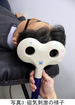 経頭蓋磁気刺激を受けている患者の頭部に装置が接触している様子。