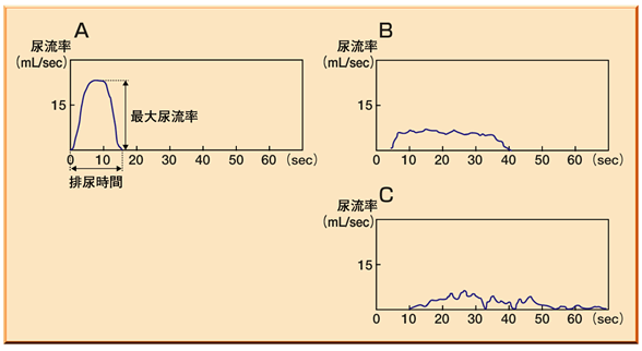 尿流率を示す3つのグラフ。