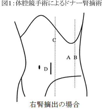 図１：体腔鏡手術によるドナー腎摘術で、右腎摘出を示す線画。