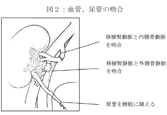 図２：腎移植の際に行う血管と尿管の吻合を示すイメージ図。