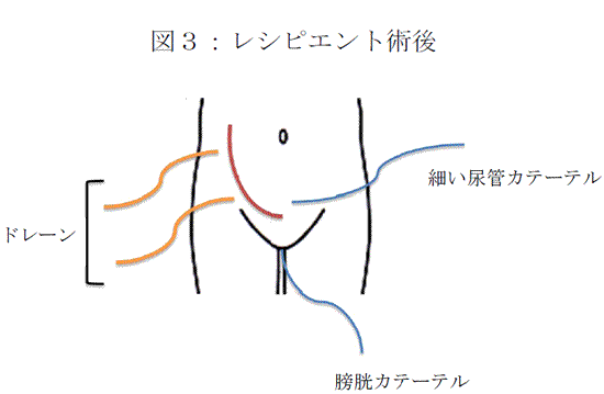 図３：術後のレシピエントの腹部図。