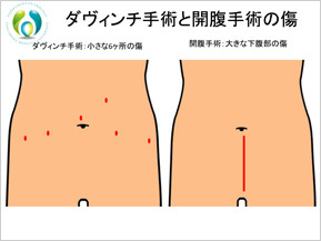 ダヴィンチ手術と開腹手術の傷口の比較図のイメージイラスト。