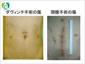 実際に行ったダヴィンチ手術後の腹部の傷と、開腹手術後の腹部の傷が並んだ比較写真。