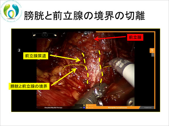 膀胱と前立腺の境界を切離する手術中の映像。
