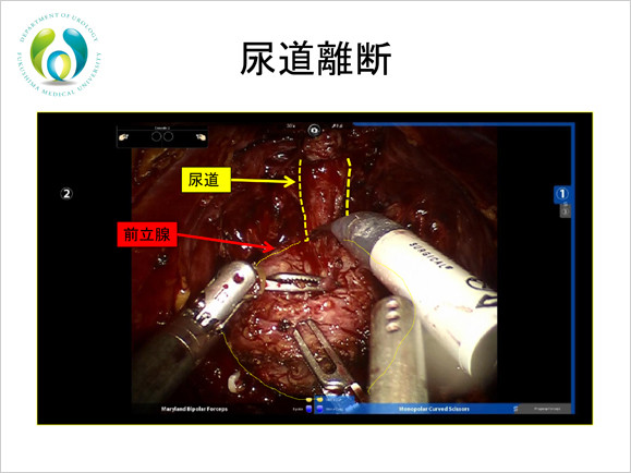 尿道と前立腺を映し、尿道離断の手術映像。