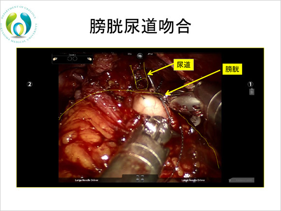 膀胱尿道吻合手術中の画像。