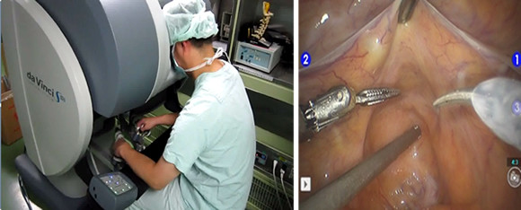 ロボット支援下前立腺全摘除術を行う小島教授の様子。