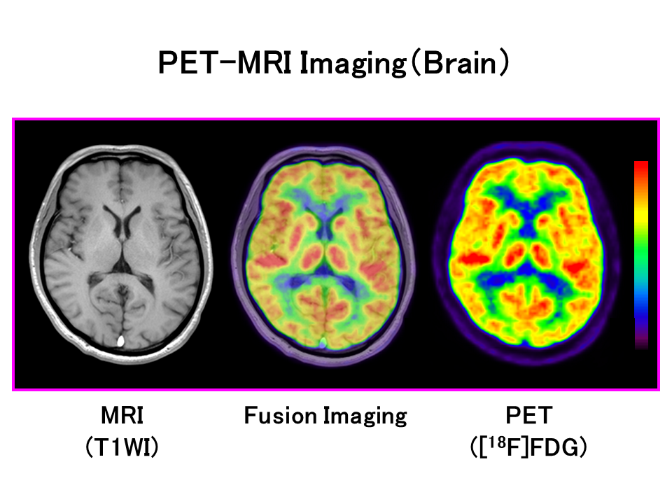 PET-MRI imaging of the brain, showcasing MRI, fusion imaging, and PET scans side by side.