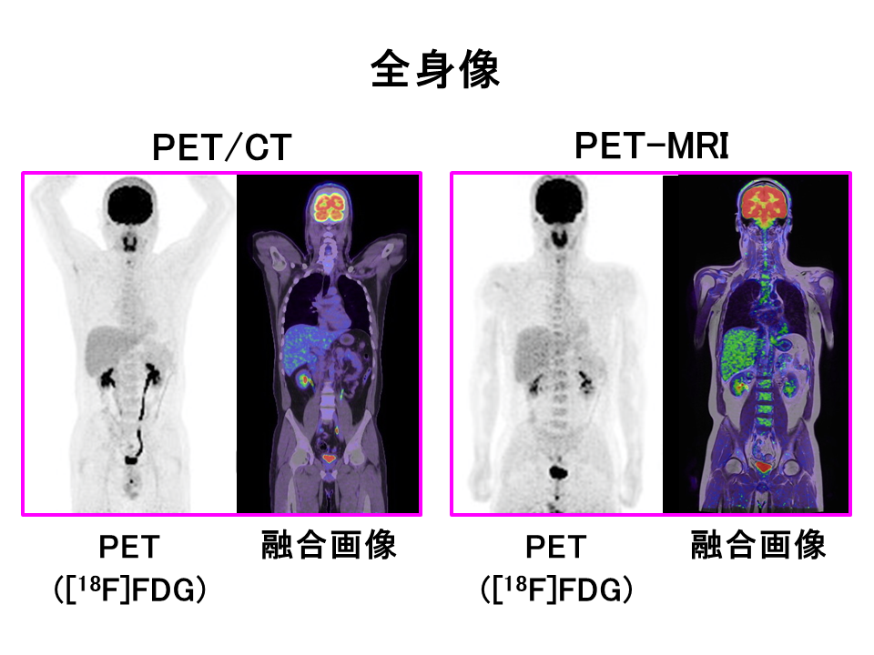 全身像、PETおよび融合画像