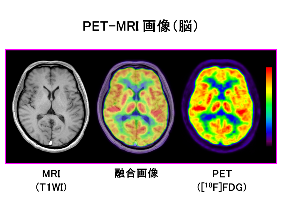 脳のPET-MRI画像