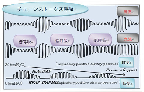 呼吸 チェーン ストークス