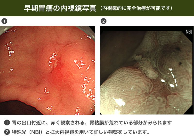 早期胃癌の内視鏡写真。左は赤みを帯びた胃粘膜、右は特殊光(NBI)と拡大内視鏡を用いた詳細な観察写真。
