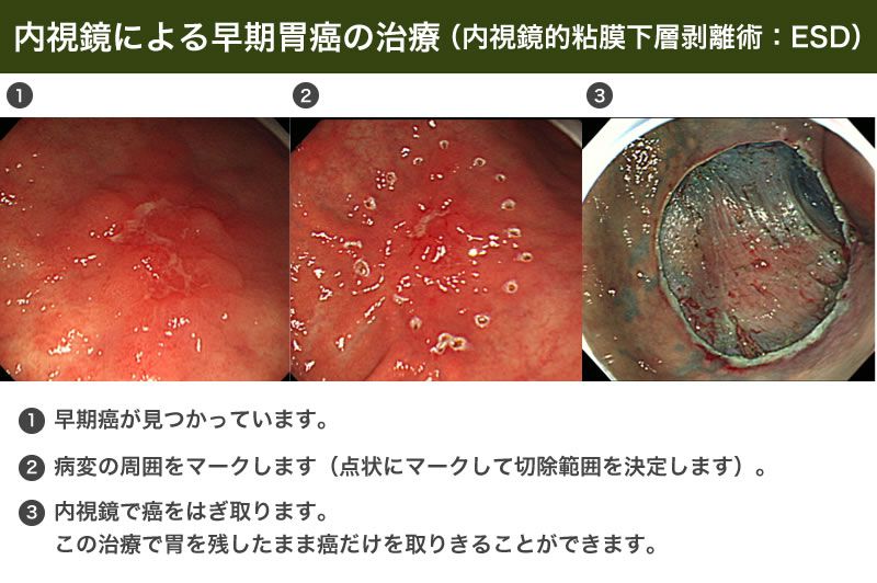 内視鏡による早期胃癌の治療プロセスの画像。1番目は病変の発見、2番目はマーク付け、3番目は癌切除後の様子を示しています。