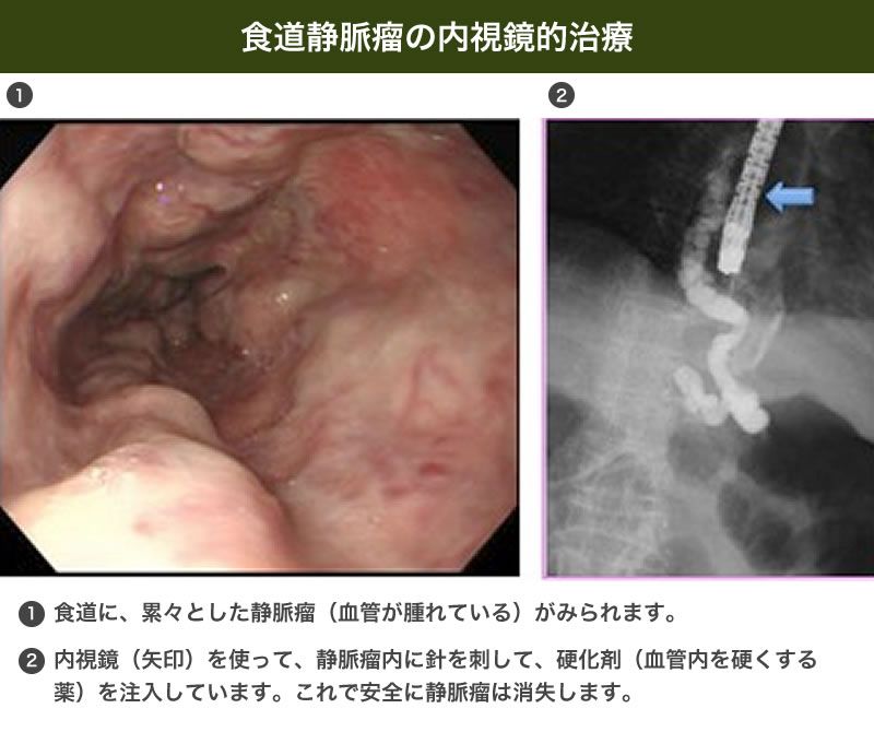 内視鏡画像で食道の静脈瘤を示し、治療として針を用いて硬化剤を注入する過程を示している説明図。