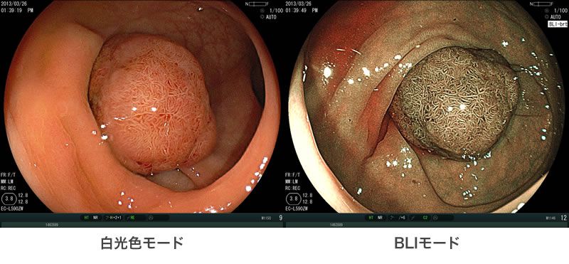 通常大腸鏡検査の画像で左は白光色モード、右はBLIモードで示されている。