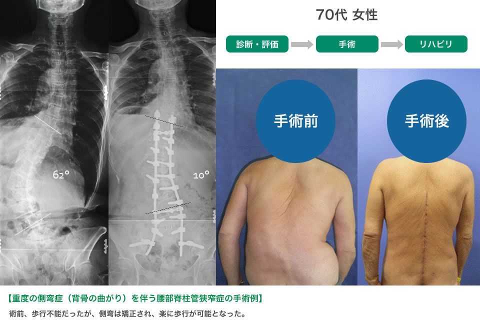 70代女性の脊柱側弯症例。左は手術前のX線と写真で湾曲が見られる。右は手術後、湾曲が矯正され改善。