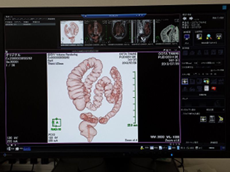 CTでスキャンした際のモニター画面。