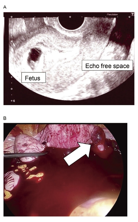 Transvaginal ultrasound showing a viable intrauterine fetus and echo-free space, indicating potential complications.