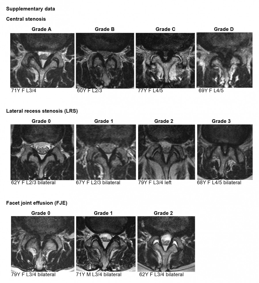 MRI images showing various grades of lumbar spinal stenosis, lateral recess stenosis, and facet joint effusion.
