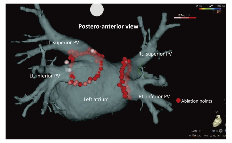 3D navigation system view during radiofrequency pulmonary vein isolation, showing ablation points around the left atrium and pulmonary veins.