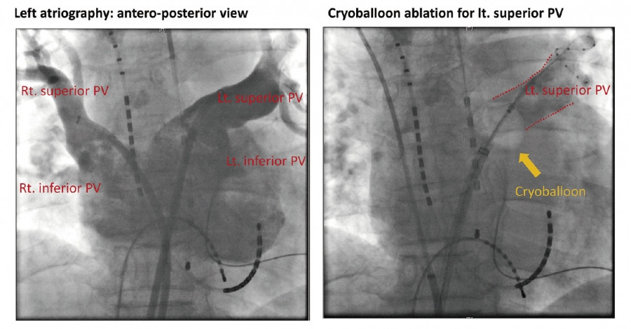 X-ray images showing cryoballoon catheter positioned for pulmonary vein isolation in atrial fibrillation treatment.